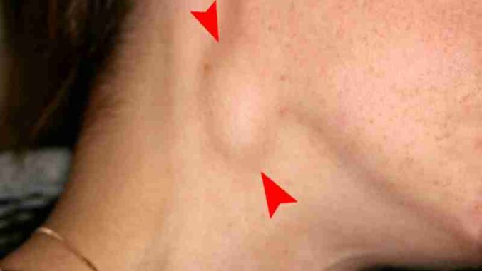 Swelling of the right neck from the spread of oral cancer., tags: die - CC BY-SA