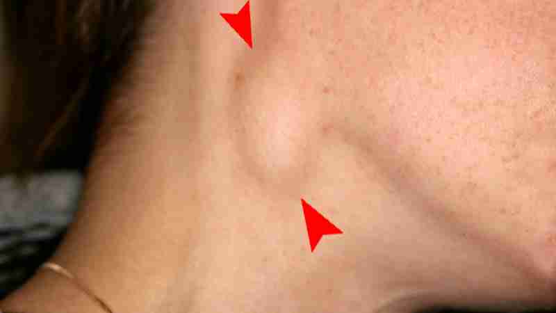 Swelling of the right neck from the spread of oral cancer., tags: die - CC BY-SA